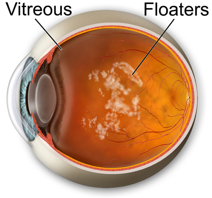 image shows vitreous floaters